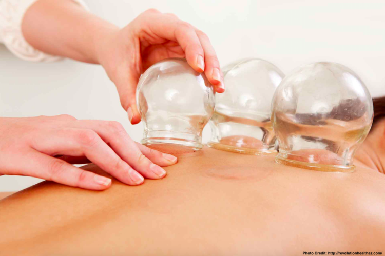 Acupuncture Treatment Boca Raton