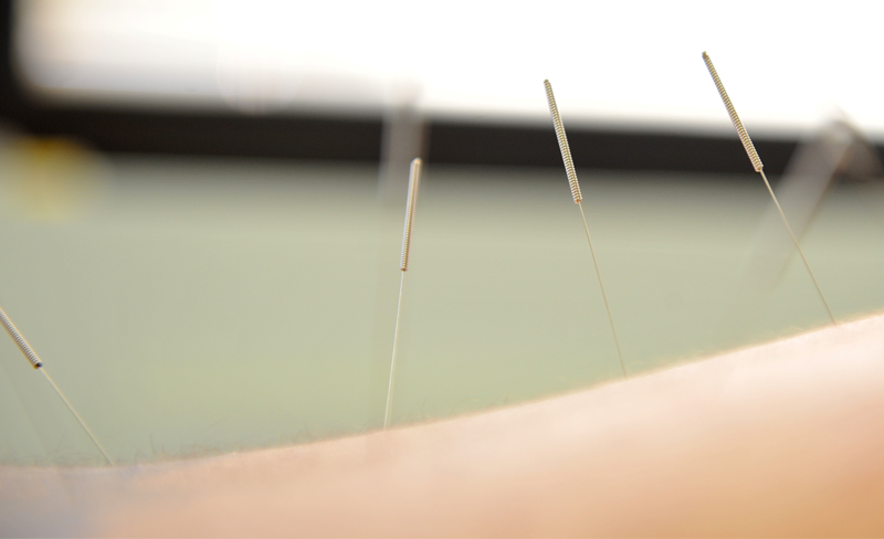 Acupuncture Boca Raton